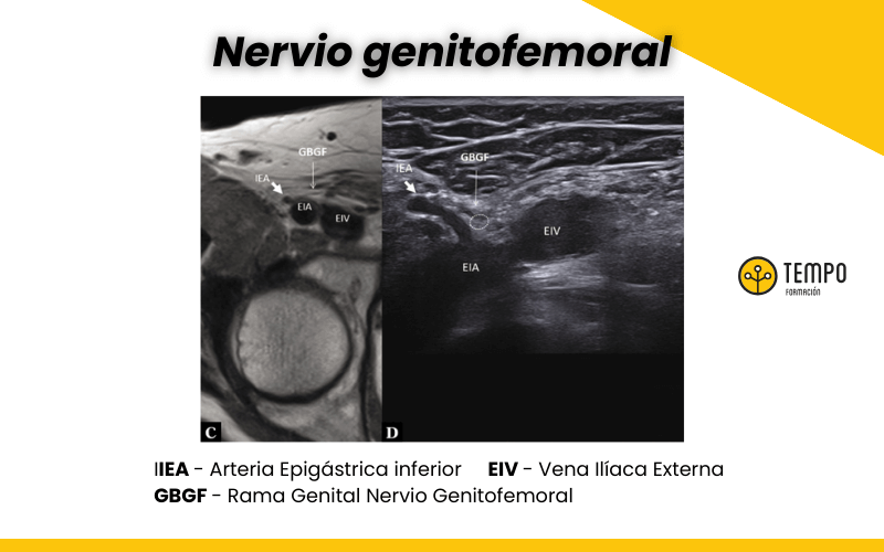 2. Nervio genitofemoral ecografia tempo formacion.png